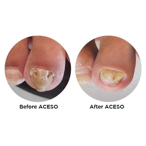 Famous Names Aceso Step One 14.8ml