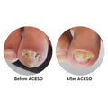 Before And After - Famous Names Aceso Step One 14.8ml, Powered By Natural Bio-Actives.