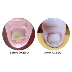 Famous Names Aceso; Before And After, Powered By Natural Bio-Actives